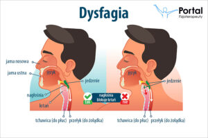 Dysfagia
