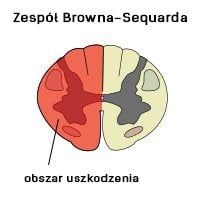 Zespół Browna-Sequarda