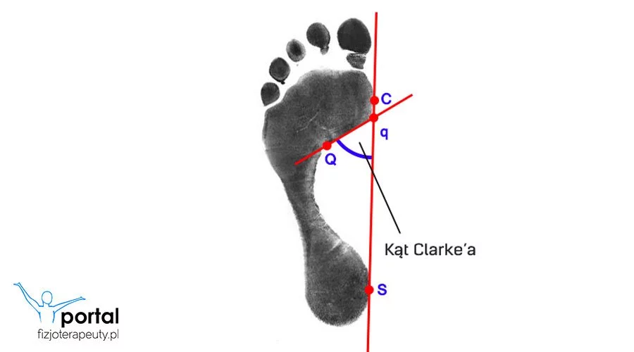 Wskaźnik kątowy Clarke'a (kąt Clarke'a)