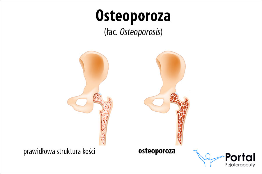 Objawy osteoporozy i fizjoterapia