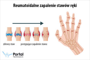 Reumatologiczne zapalenie stawów ręki