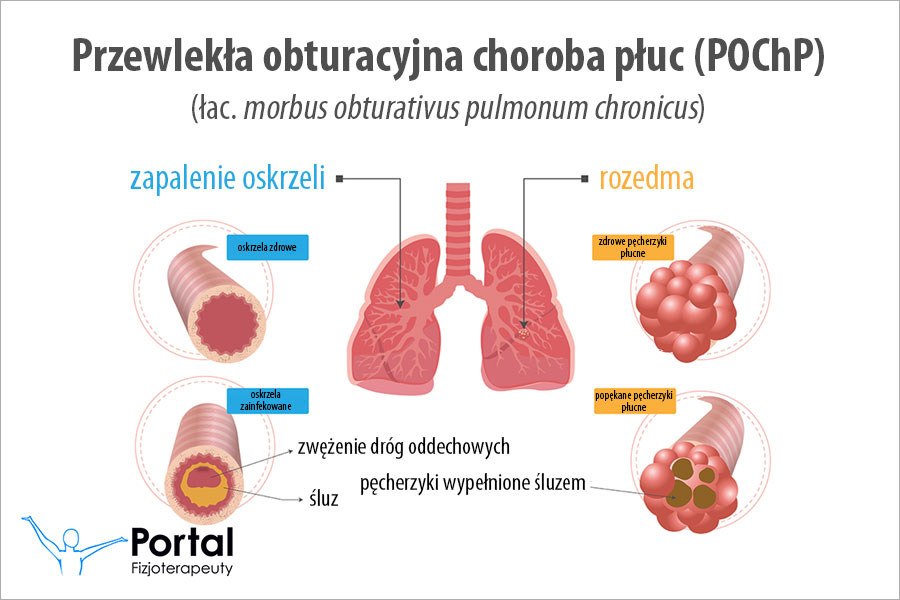 Przewlekła obturacyjna choroba płuc (POChP)