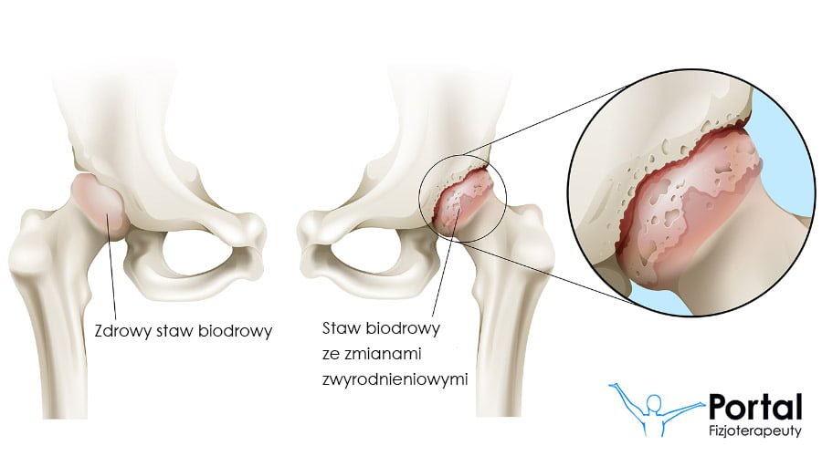 tratarea sării pentru artroză de ce doare în articulația șoldului când stai