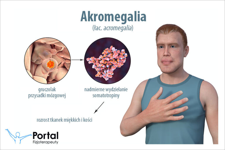 Akromegalia