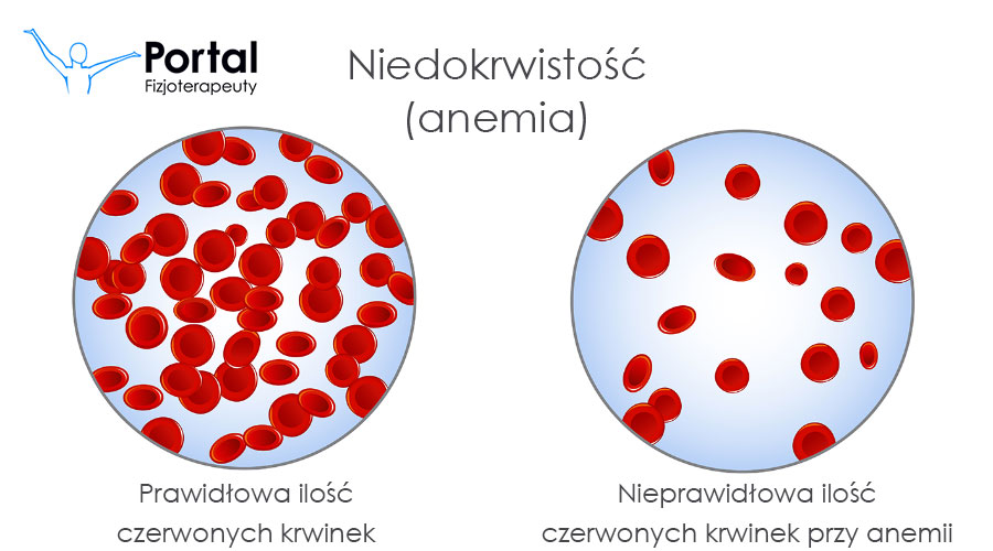 anemia z niedoboru zelaza