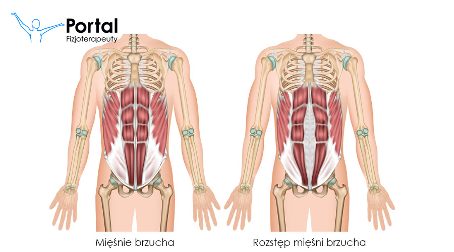 Rozstęp mięśni brzucha