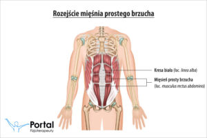 Rozejście mięśnia prostego brzucha