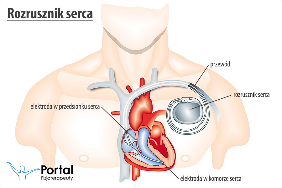 Rozrusznik serca (stymulator serca)