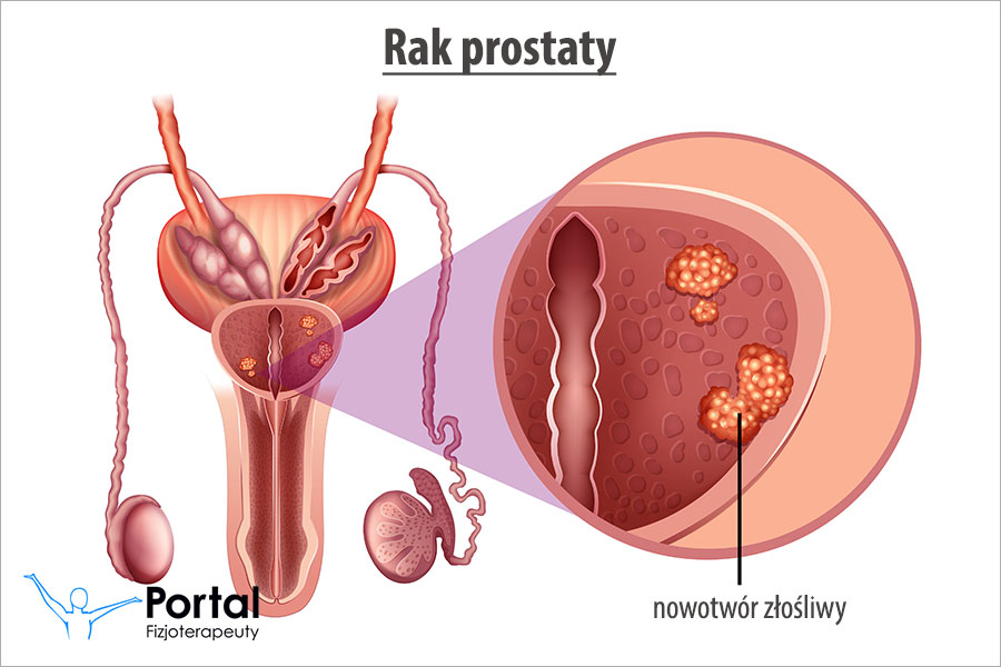 Rak prostaty