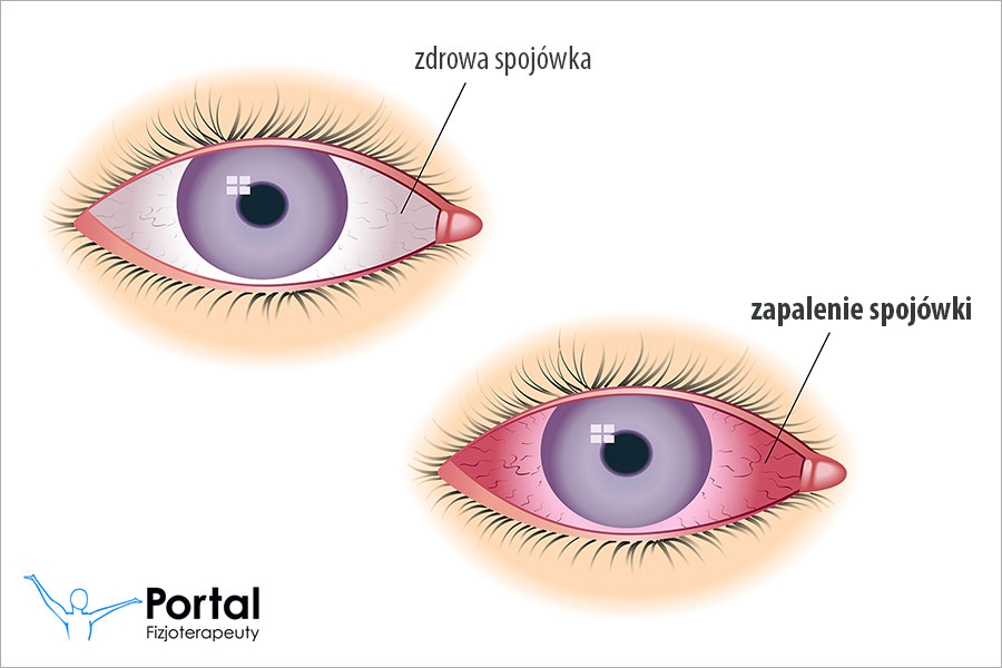 Infekcja oka (zapalenie spojówki)