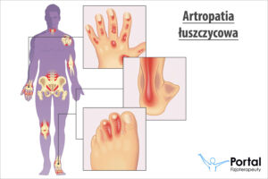Artropatia łuszczycowa