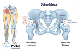 Osteofitoza