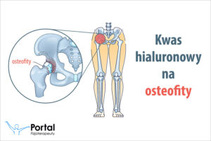Kwas hialuronowy na osteofity