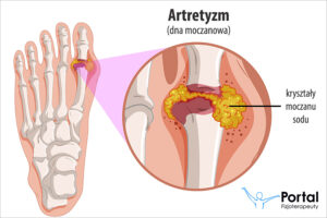 Artretyzm (podagra lub dna moczanowa)
