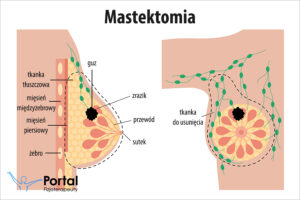 Mastektomia