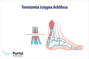 Tenotomia