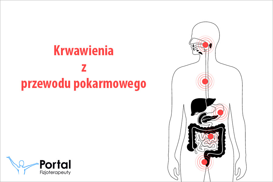 Krwawienia z przewodu pokarmowego