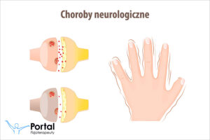 Choroby neurologiczne