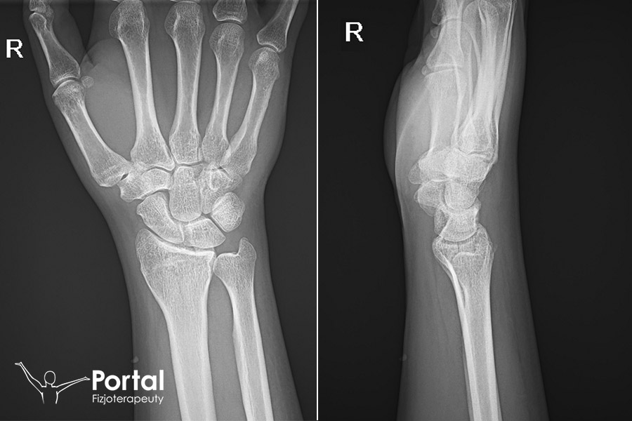 Powikłania po złamaniu kości promieniowej