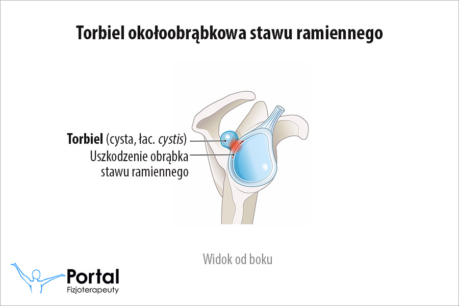 Torbiel (cysta, łac. cystis)