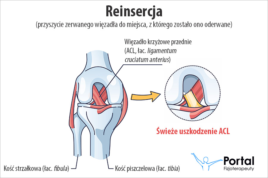 Reinsercja