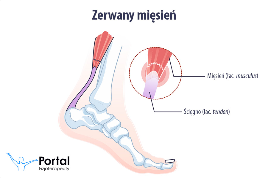 Zerwany mięsień