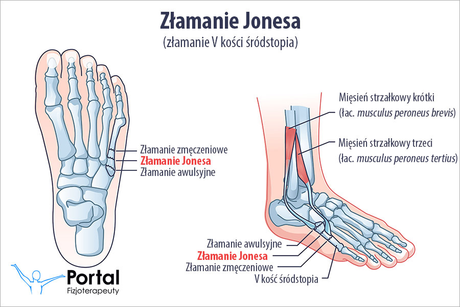 Złamanie Jonesa (złamanie V kości śródstopia)