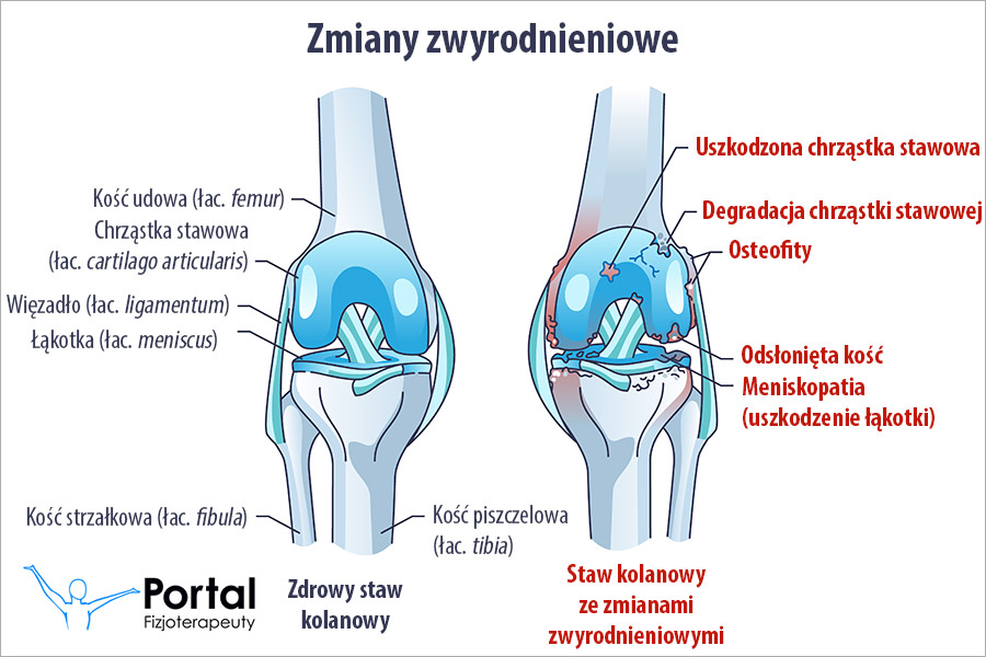 Zmiany zwyrodnieniowe