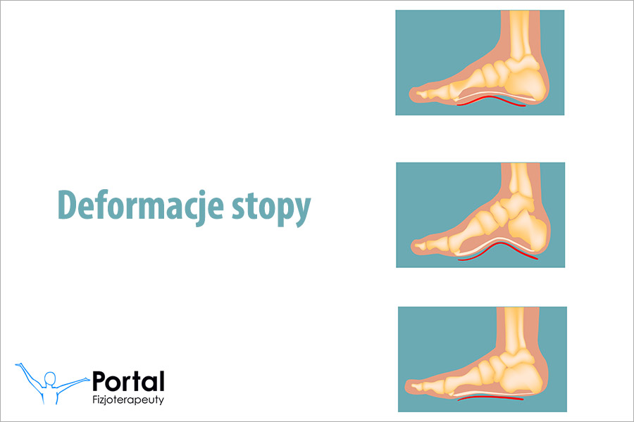 Deformacje stopy