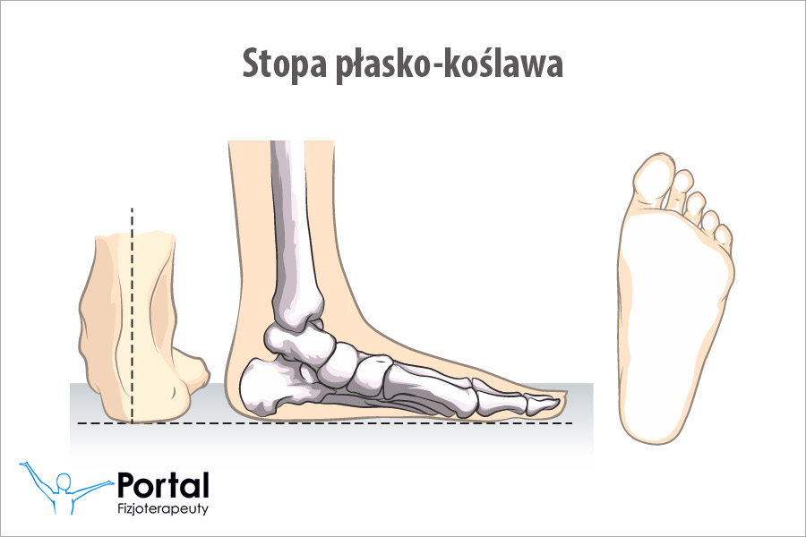 Stopa płasko-koślawa