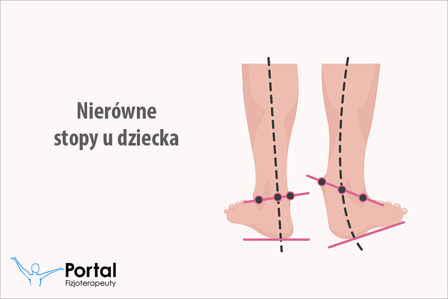 Nierówne stopy u dziecka