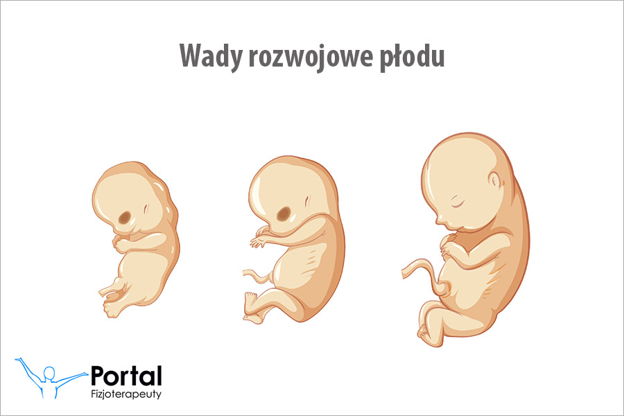 Wady rozwojowe płodu