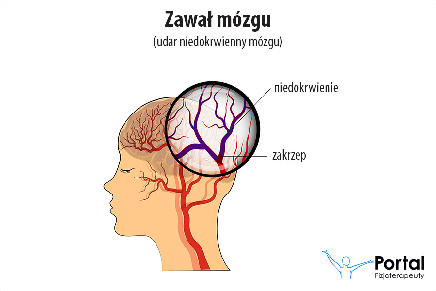 Zawał mózgu