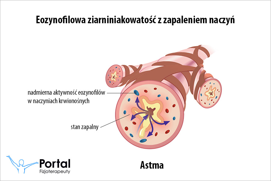 Eozynofilowa ziarniniakowatość z zapaleniem naczyń