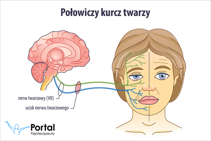 Połowiczy kurcz twarzy