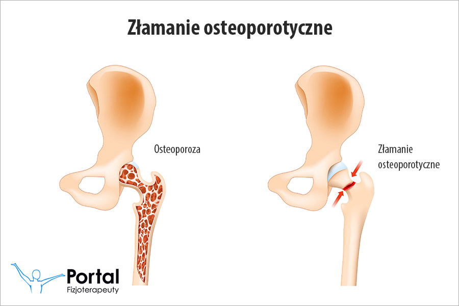 Złamanie osteoporotyczne