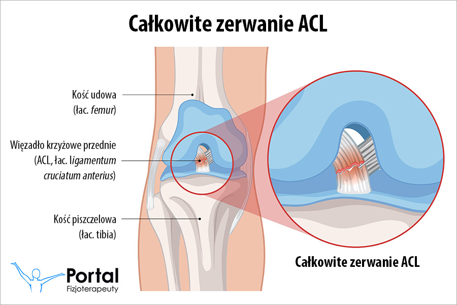 Całkowite zerwanie ACL