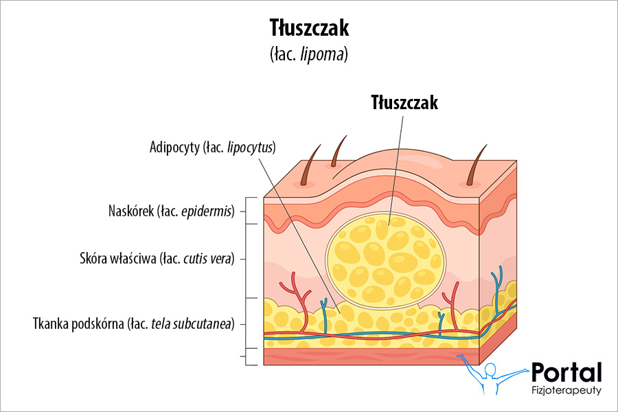 Tłuszczak (łac. lipoma)