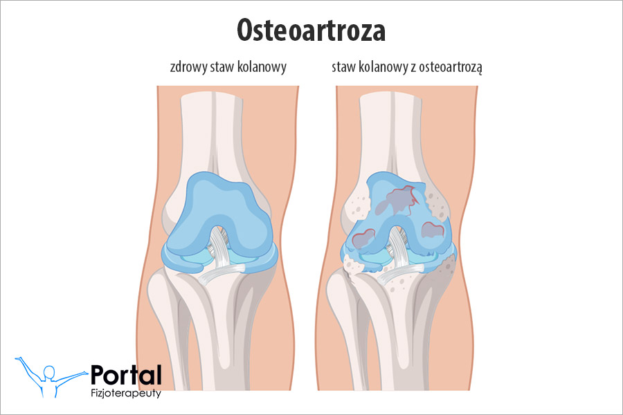 Osteoartroza