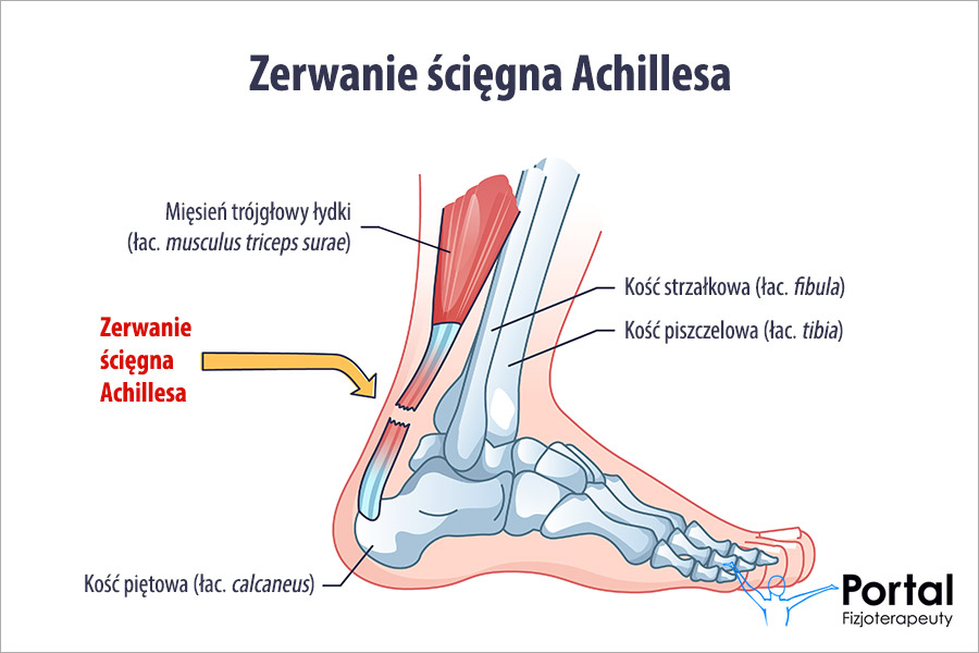 Zerwanie ścięgna Achillesa