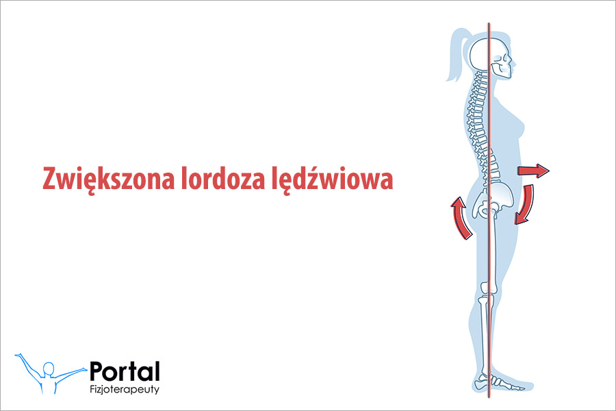 Zwiększona lordoza lędźwiowa