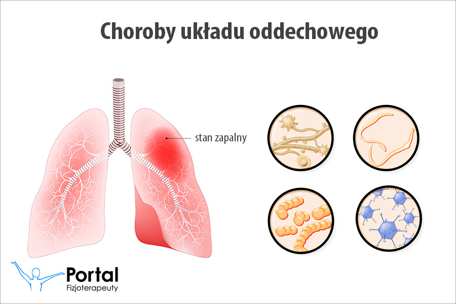 Choroby układu oddechowego