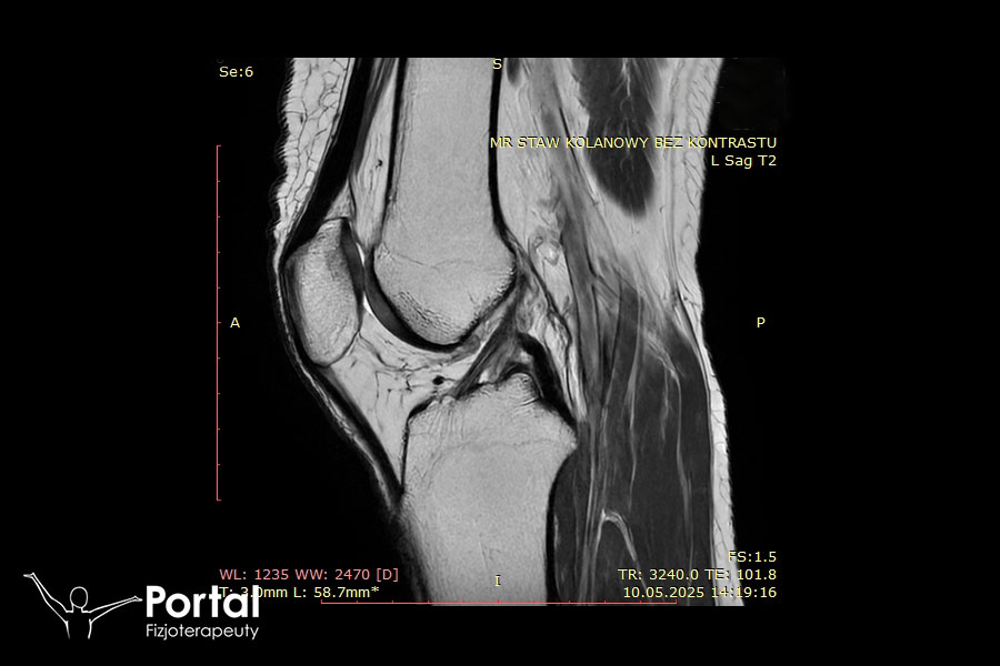Naderwane ACL
