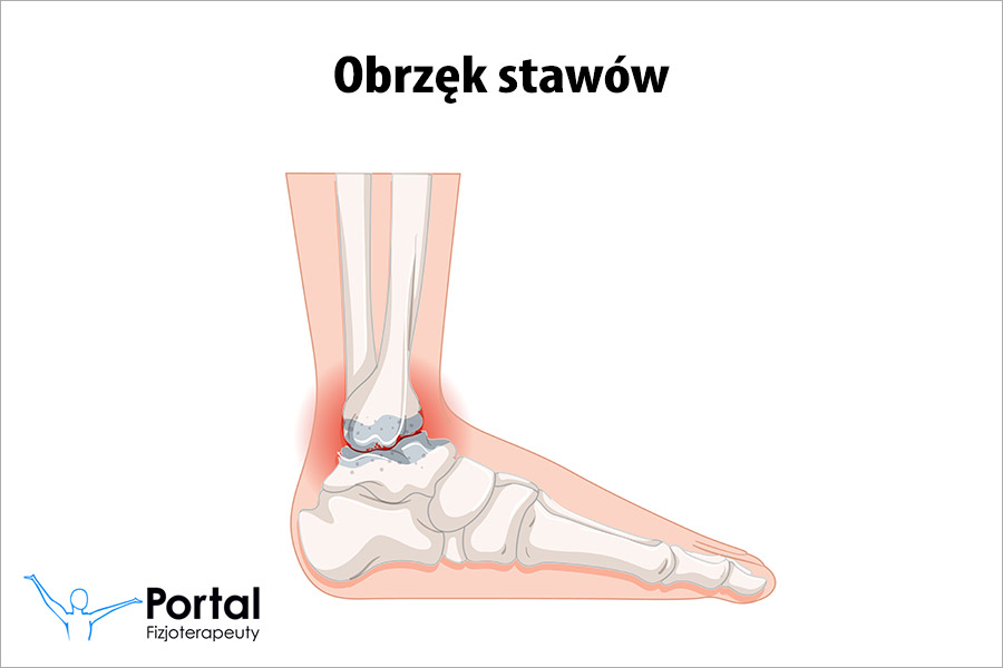 Obrzęk stawów