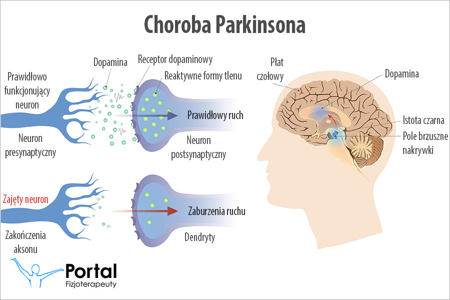 Choroba Parkinsona