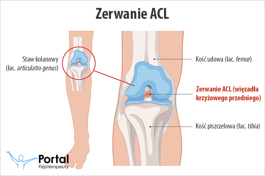 Zerwanie ACL