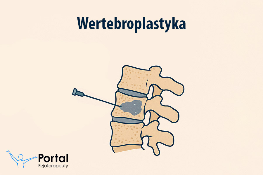 Wertebroplastyka