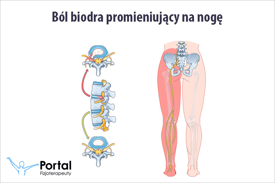 Ból biodra promieniujący na nogę