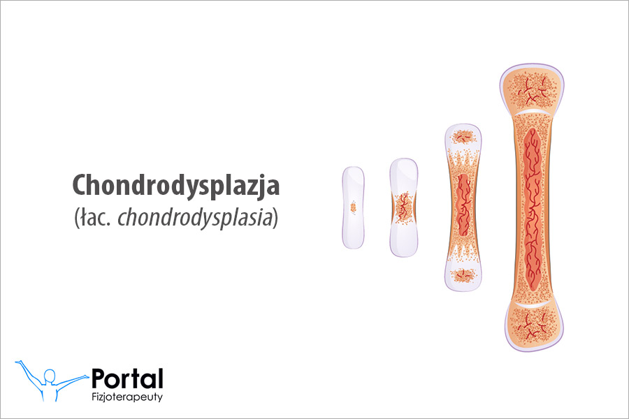Chondrodysplazja (łac. chondrodysplasia)