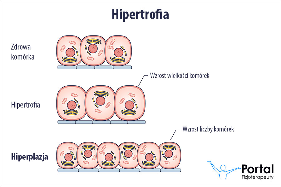 Hiperplazja